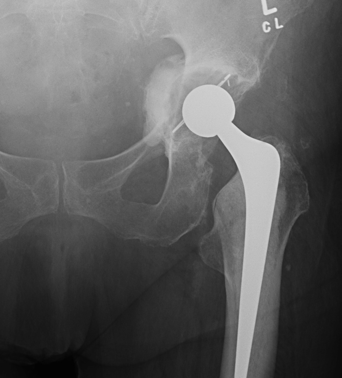 Intrapelvic Cement